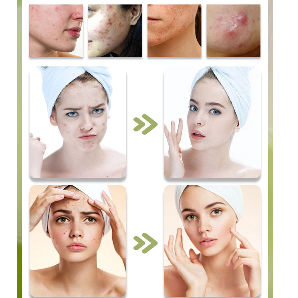 KStims – crème Anti-acné pour  - Tea Tree Spot Treatment avis et prix